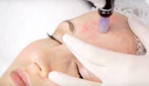 6 Micro-needling Package