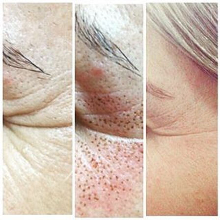 Crow Feet Wrinkle Reduction -plasma