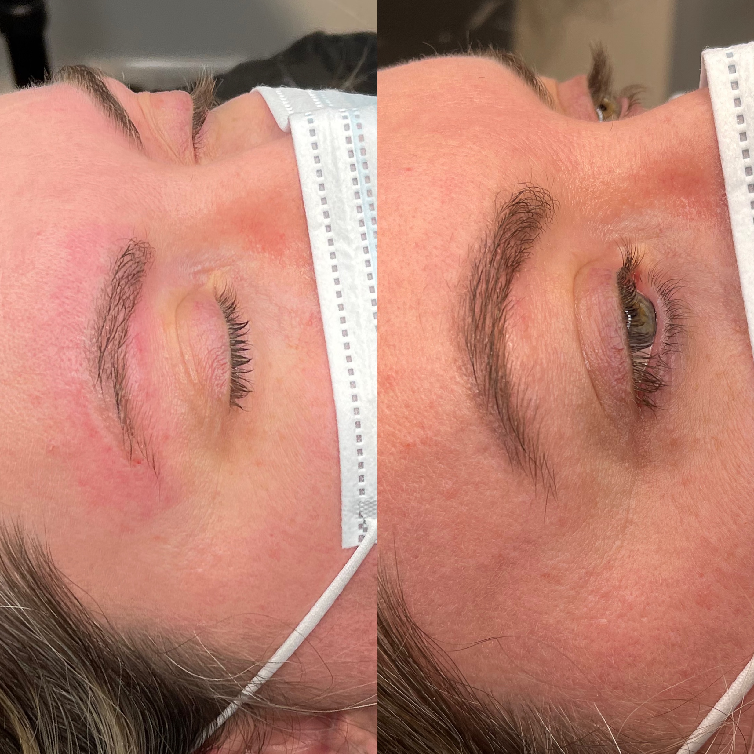 Permanent Makeup Removal at Sapphire in Greensboro, NC