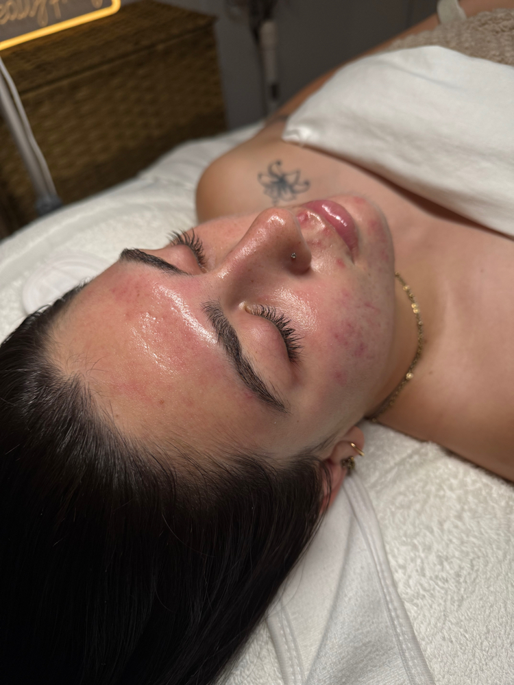 Consultation + Acne Program at Nalani.esthetics in Bakersfield, CA