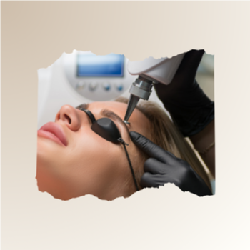 PMU Laser Removal Session