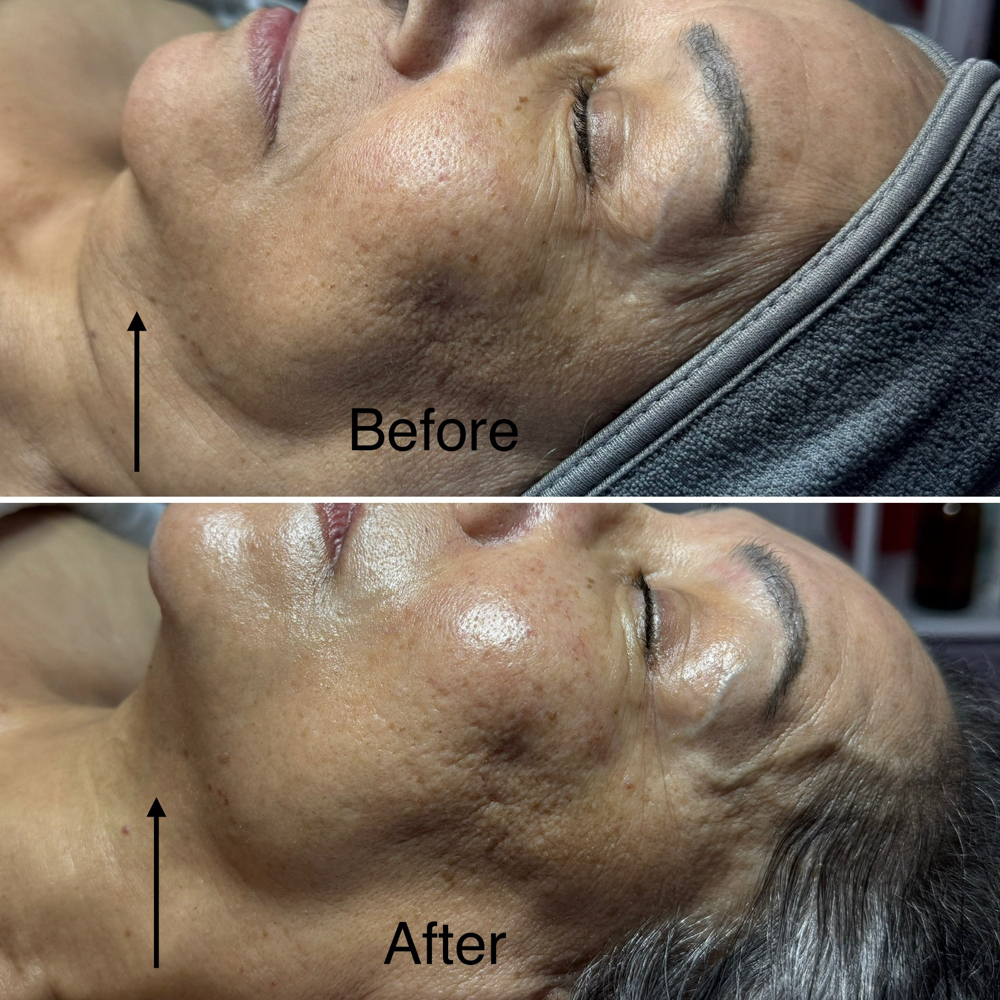 Korean Face Lift Facial