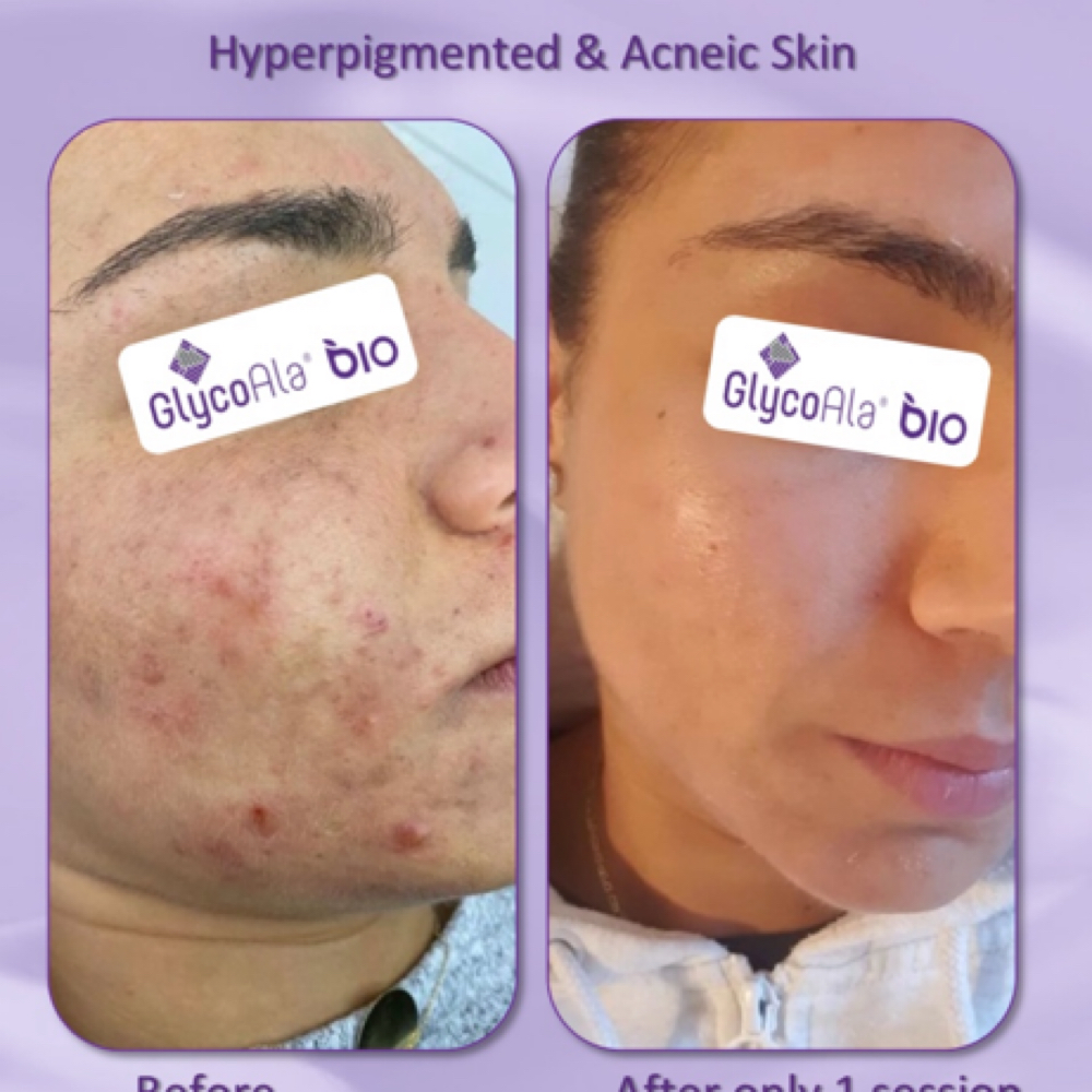 GlycoAla Bio Treatment at Sincere Skin Therapy in Windsor, CO
