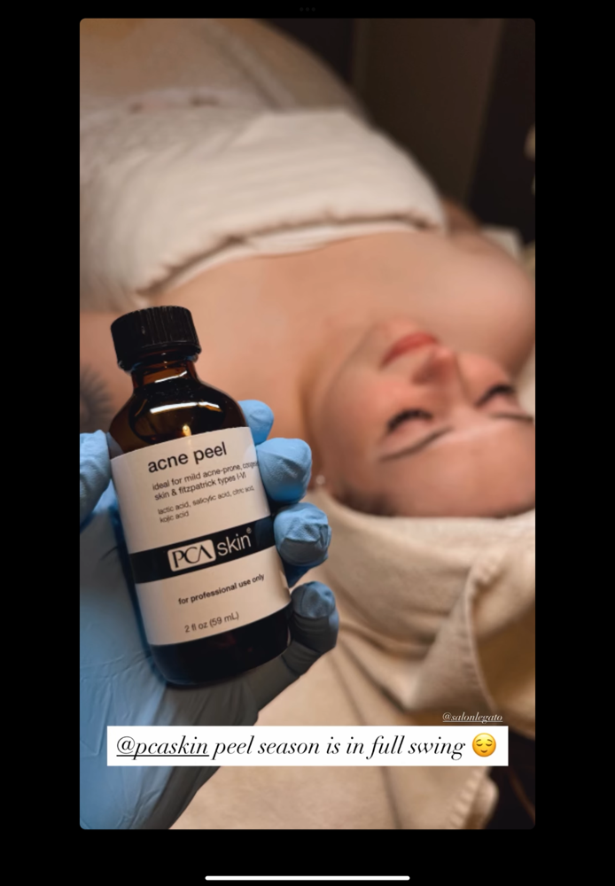 Peelings - Tratamiento 3