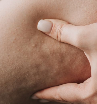 Premium Cellulite Session