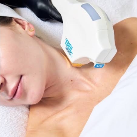 BBL Full Face/Neck + Chest at The Skin Concierge in Northbrook, IL