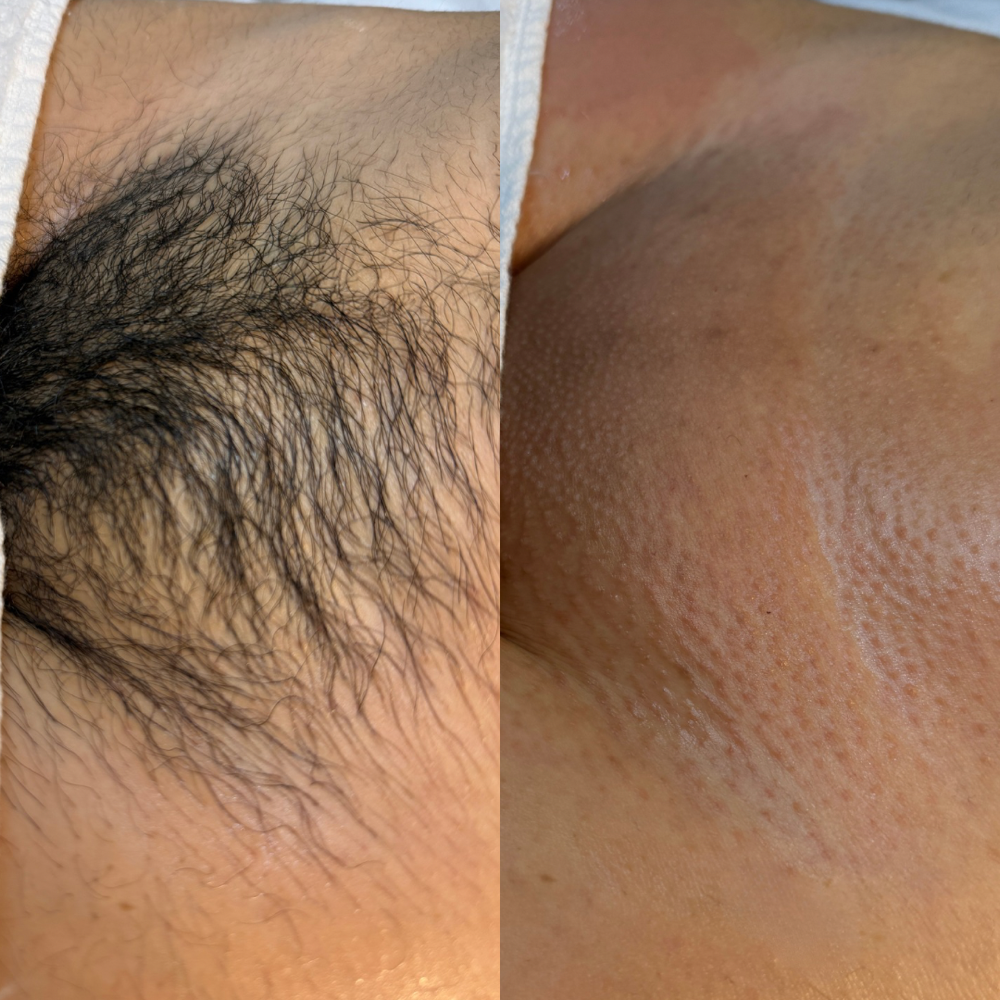 Brazilian Wax