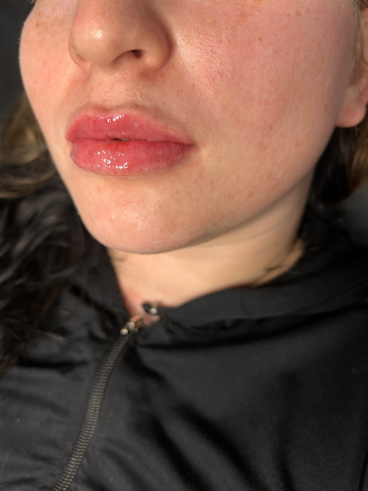 Lip Filler 1/2 ML
