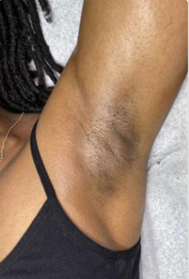 Underarm at Sonder Skin in Newport News, VA