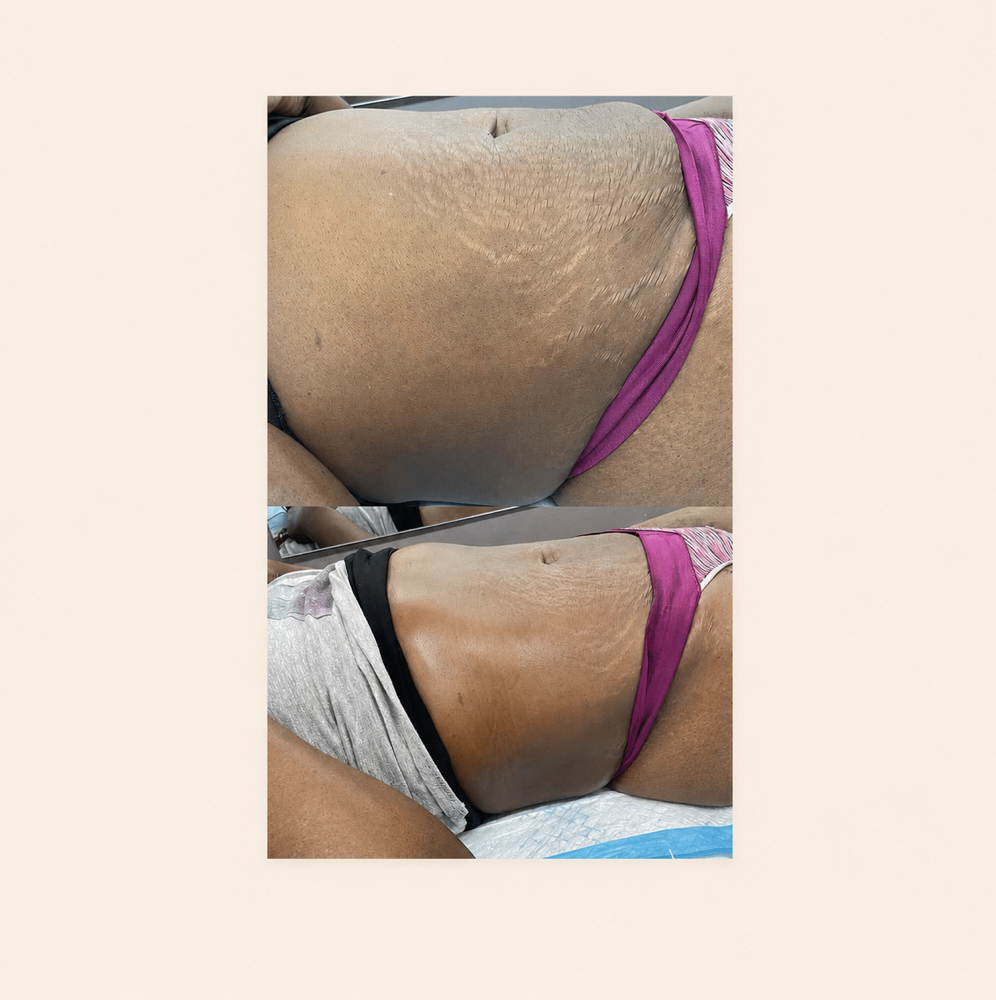 Waist Sculpt - 9 Session Package at BODIEDBYNICKEI LLC in The Bronx, NY