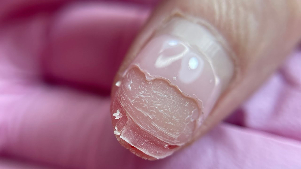 Recovery Base For Damaged Nails