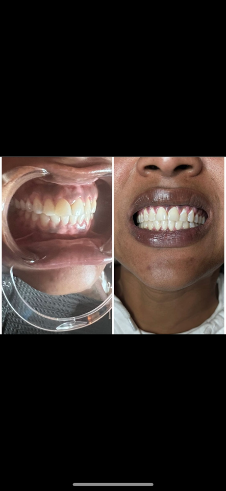 Custom Whitening
