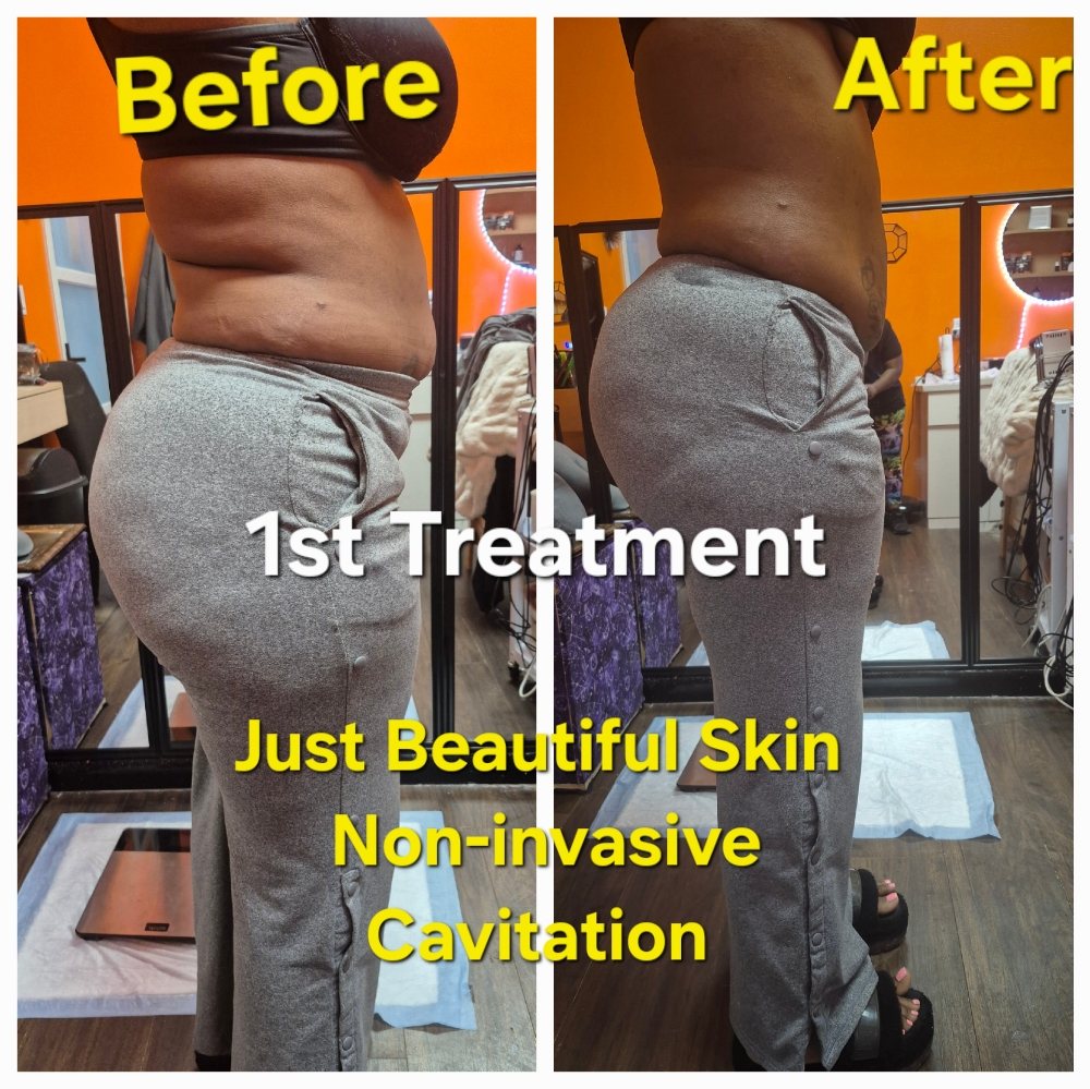Waist Treatment