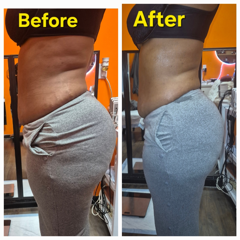 4 Session Wasteline Lipo Cavitation