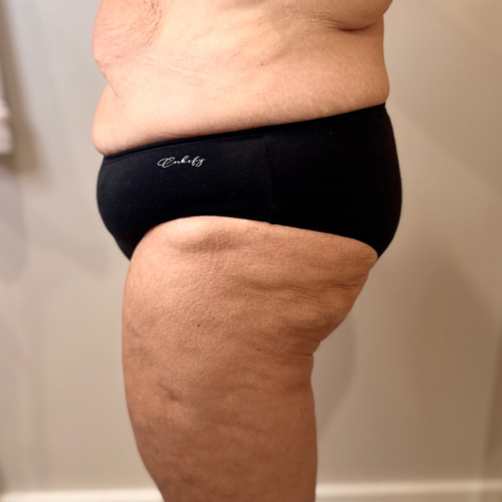 Cellulite reduction