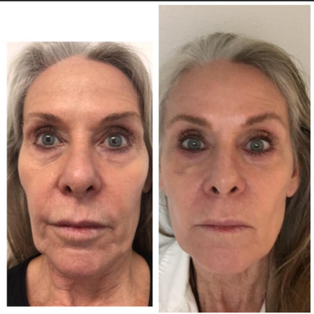 Hifu- Lunch Time Lift / Skinsheek at Marco Island Aesthetics
