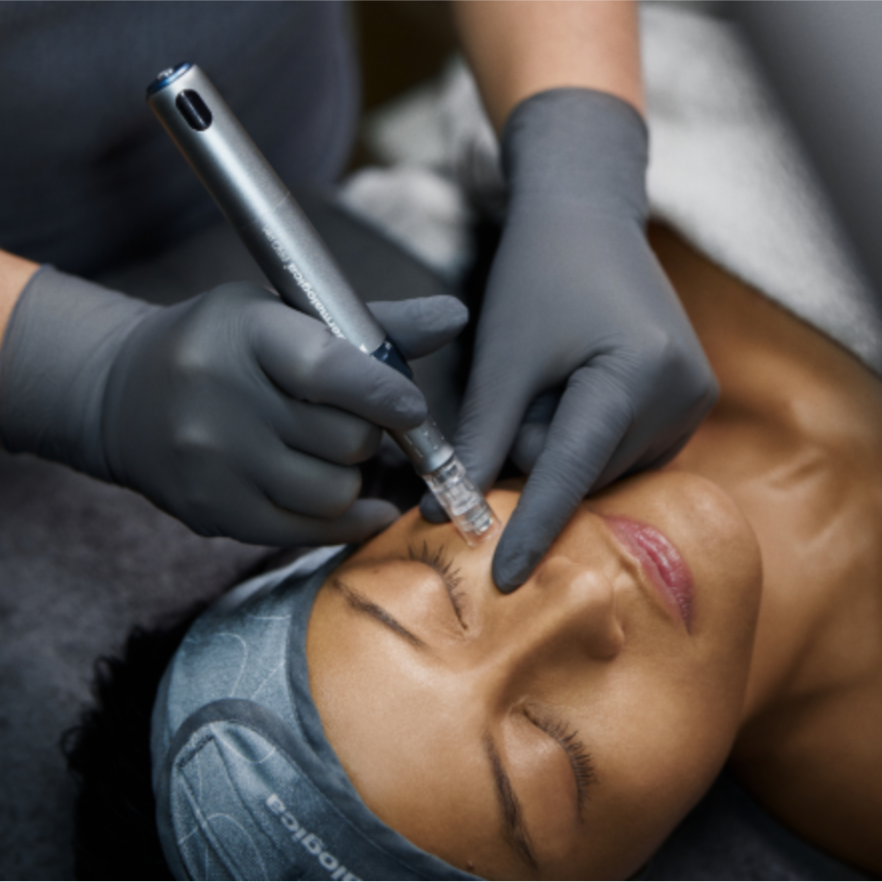 Microneedling (Face Only) at Hometown Haven in Superior, NE