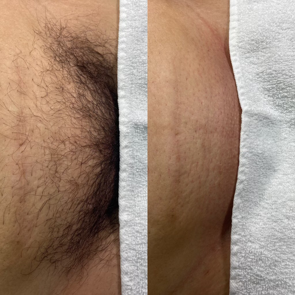 Female Brazilian Wax