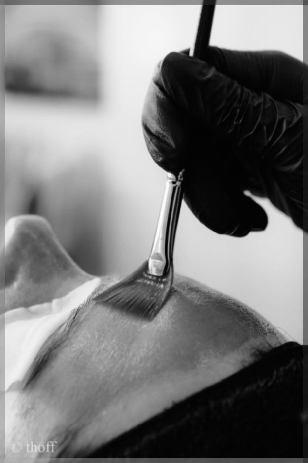 Chemical Peels