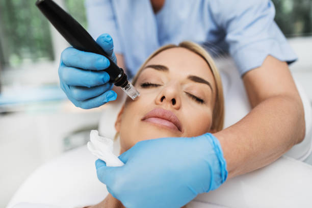 Microneedling - Face with Chemical