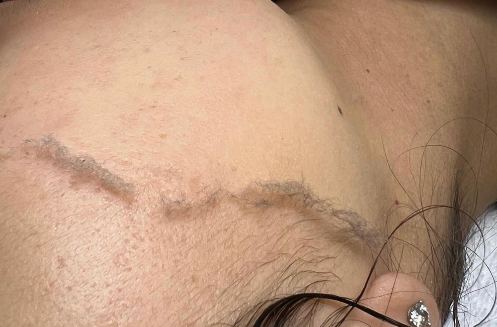 Dermaplane Facial at Jisell Aesthetics in Houston, TX