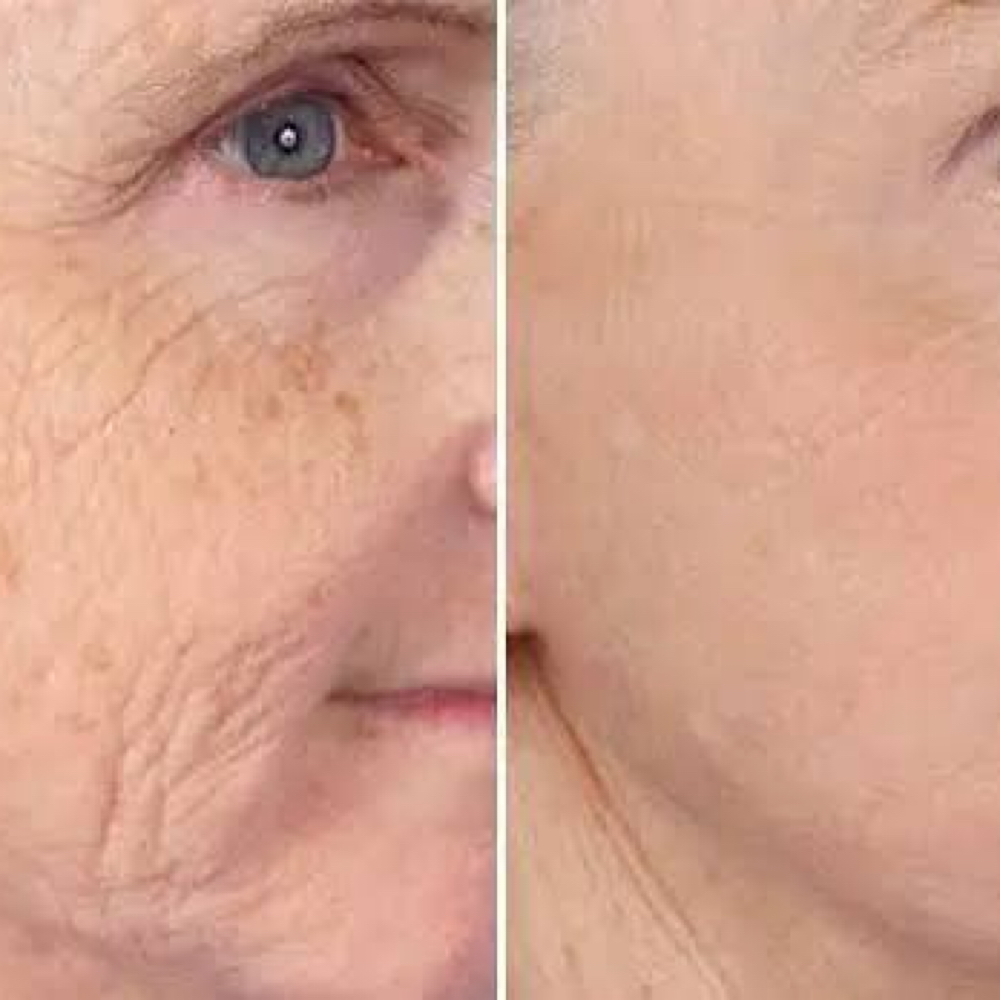 Anti-aging Peel at Haus of Beauty Studio in Hialeah, FL