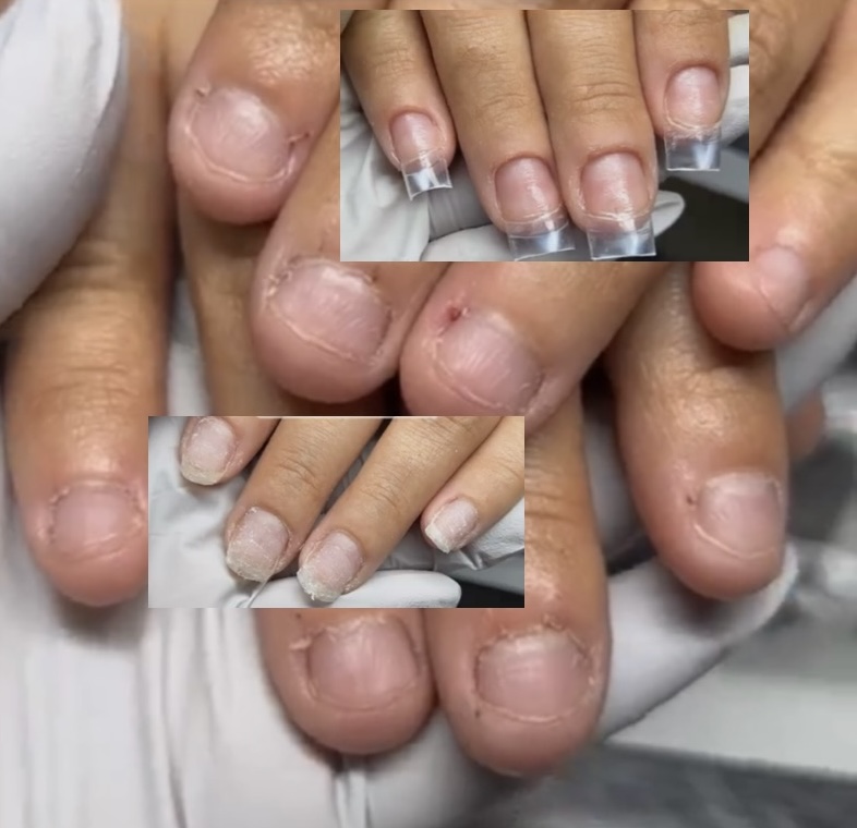 Bitten Nails