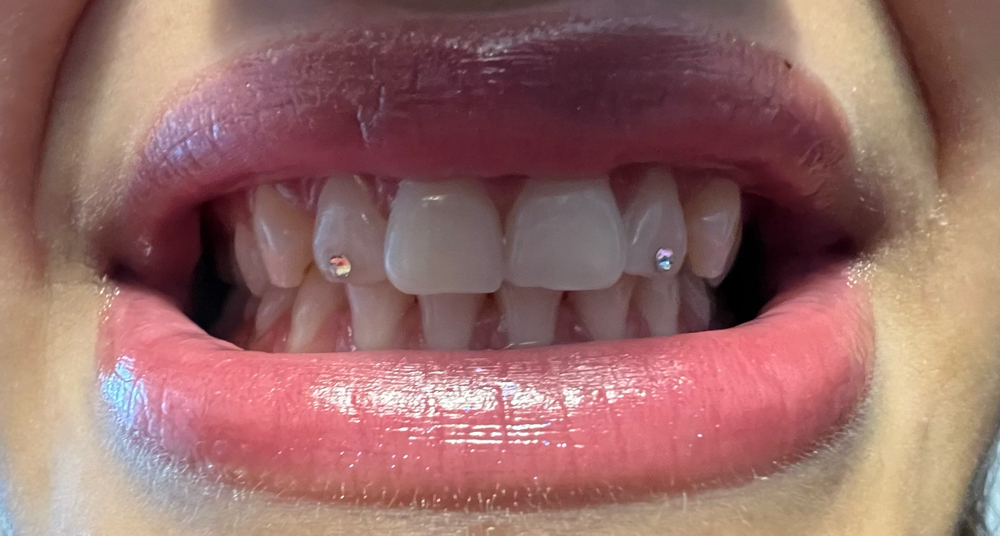 2 Tooth Gems