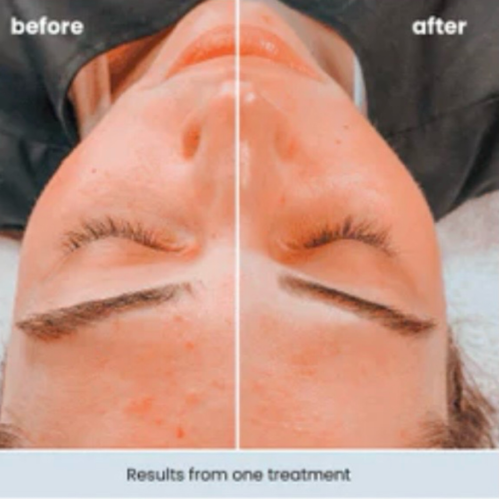 Oxygen Rx Treatment at Restore Balance in Milford, DE