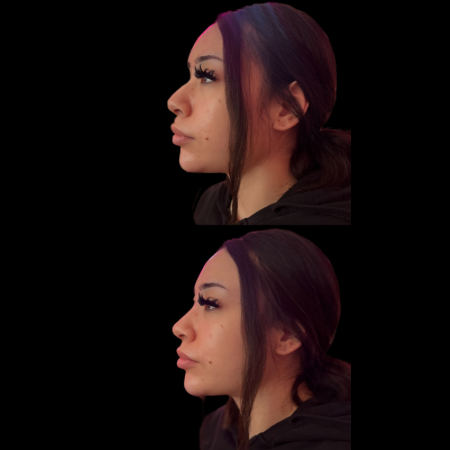 Non Surgical Nose Job