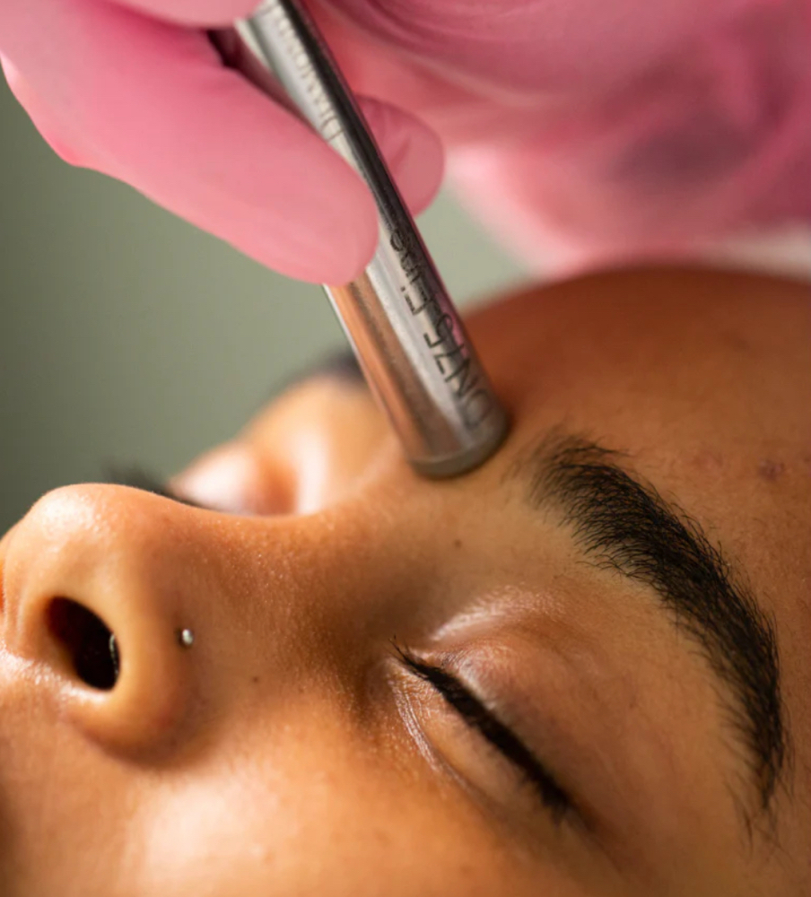 Microdermabrasion