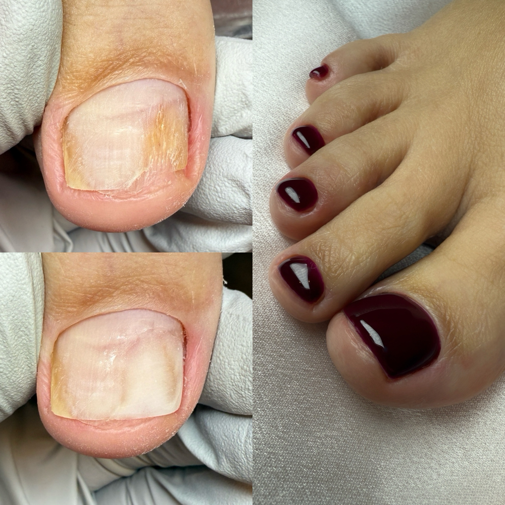 Nanoflex Toenail Reconstruction