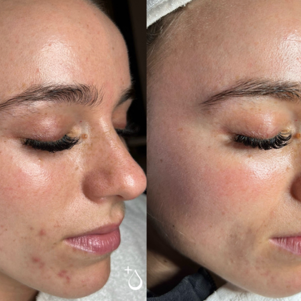 Acne Facial at Skin Daddie in Las Vegas, NV