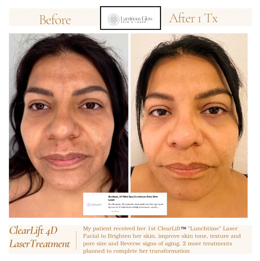 ClearLift™ Laser Skin Rejuvenation at Luminous Glow Skin & Laser in Buckeye, AZ
