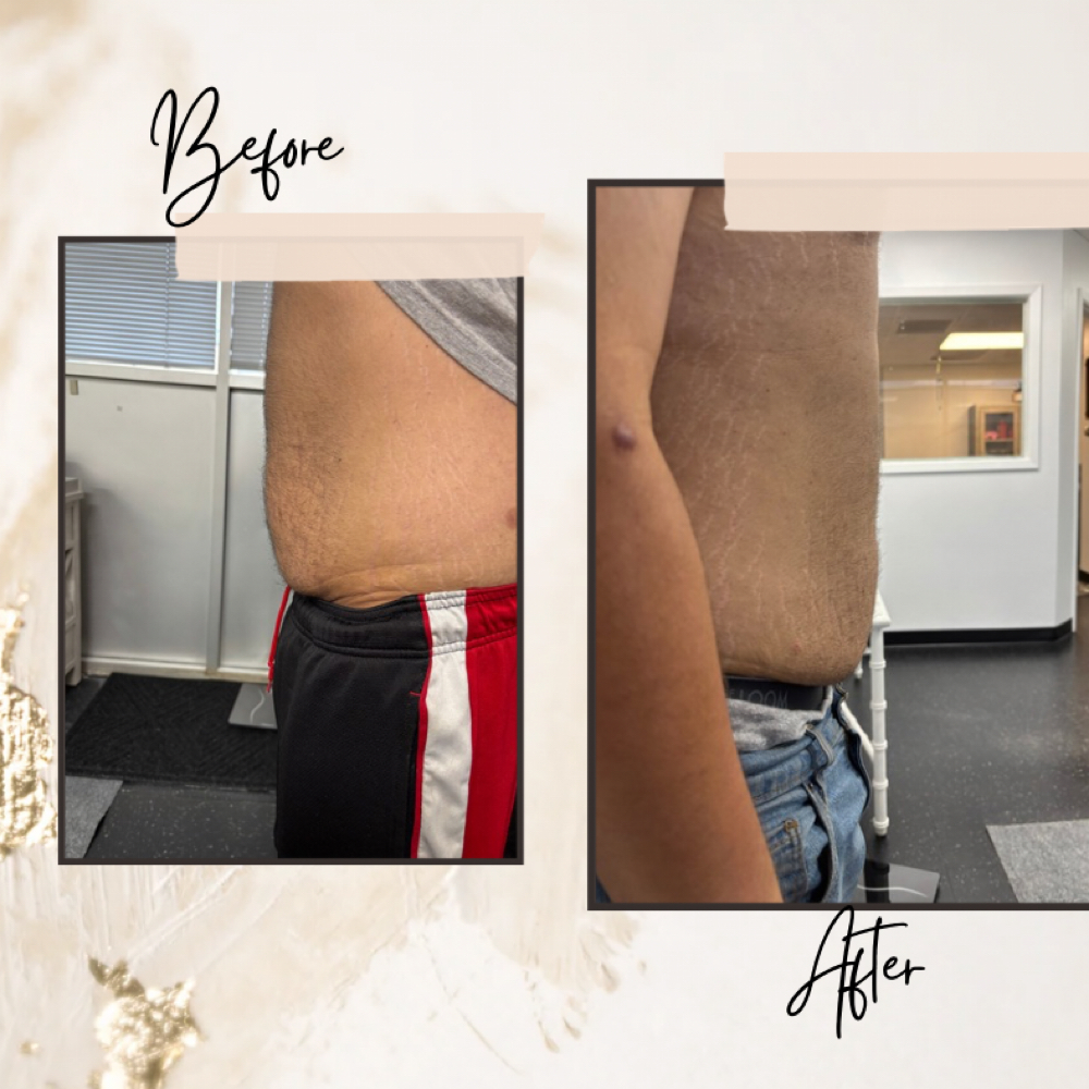 PCDC Lower Stomach Dissolve at Davis Wellness & Aesthetics in Cleburne, TX