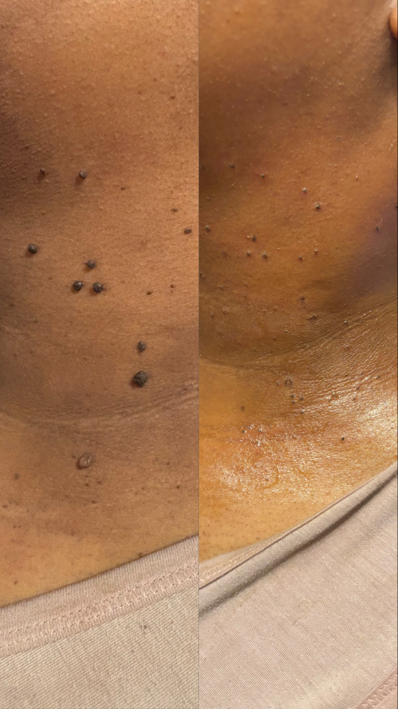 DPN/Skin Tag Removal at Aesthetics 189 in Hyattsville, MD