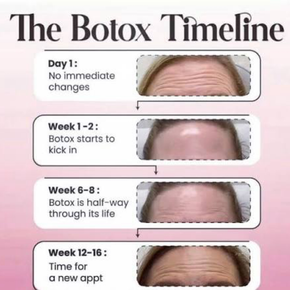 Botox Followup at XKIN BEAUTY in McAllen, TX