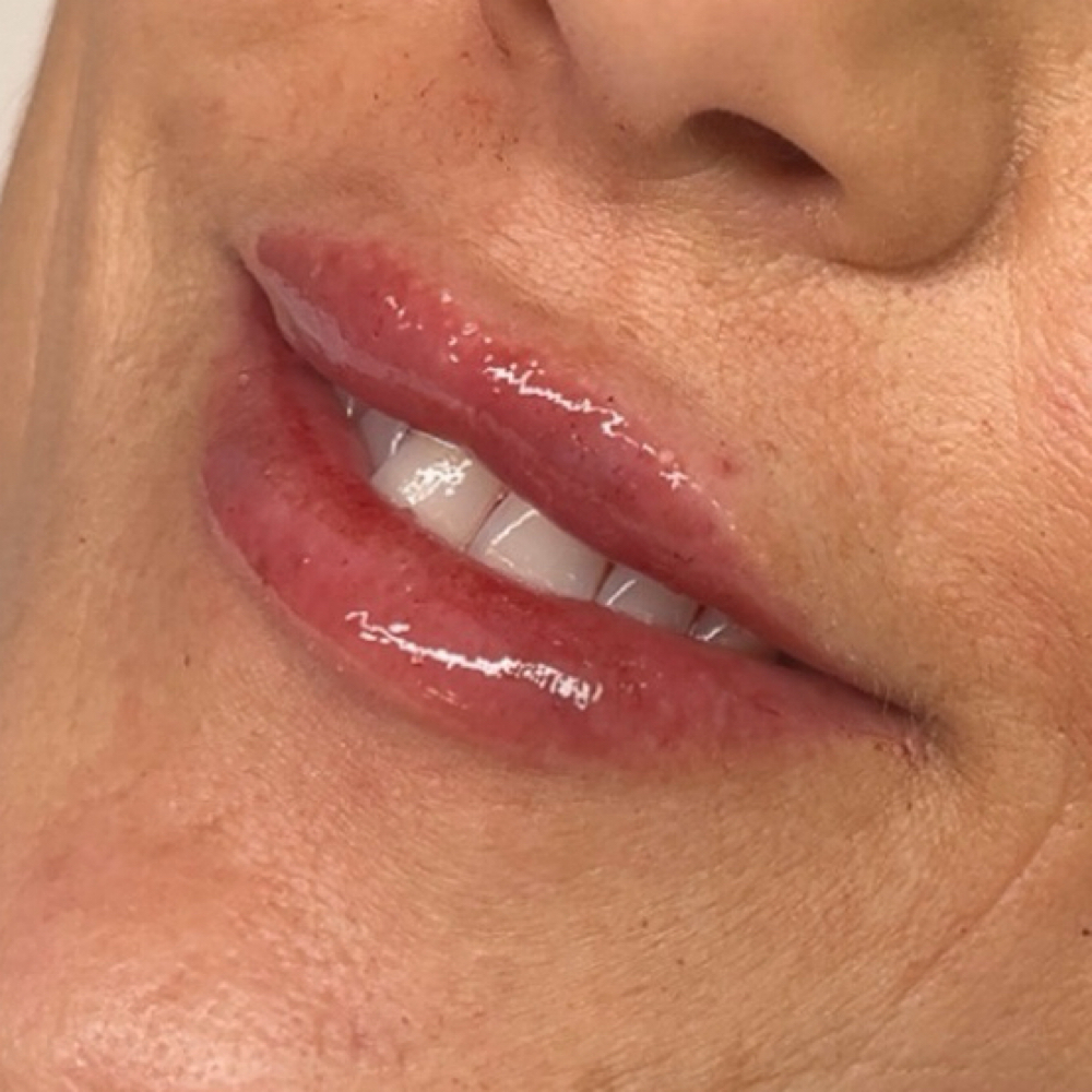 Cupid’s bow lift .3ML at Glam X Sam MedBeauty in Andrews, TX