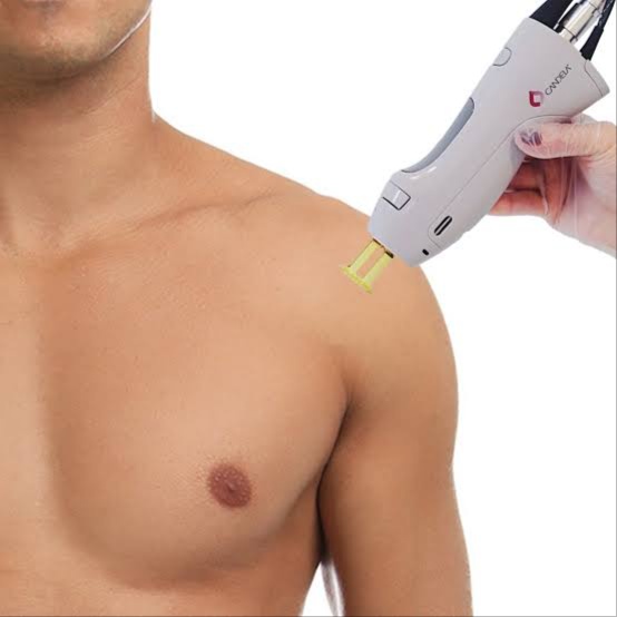 Shoulders at Illumina Aesthetics and Laser in Palm Beach Gardens, FL