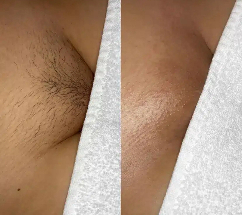 Brazilian Wax
