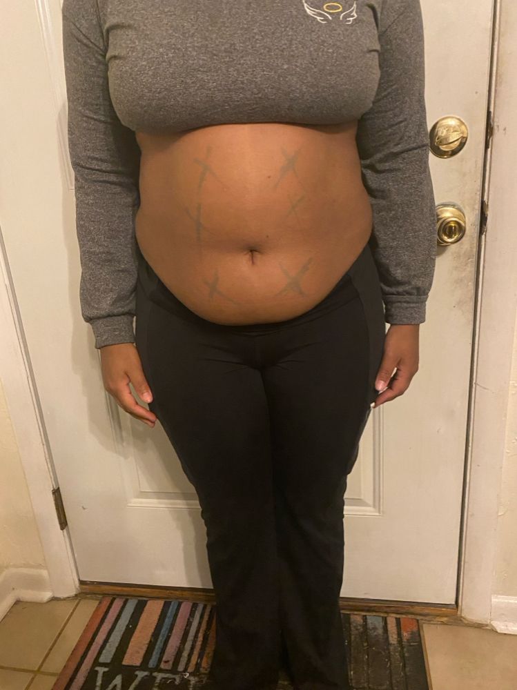Mommy makeover