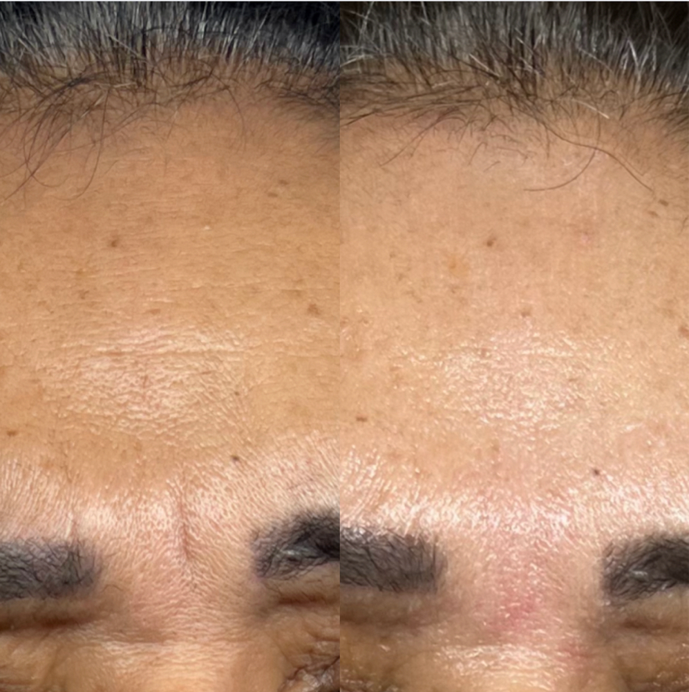 Skin Tightening Facial 🫧
