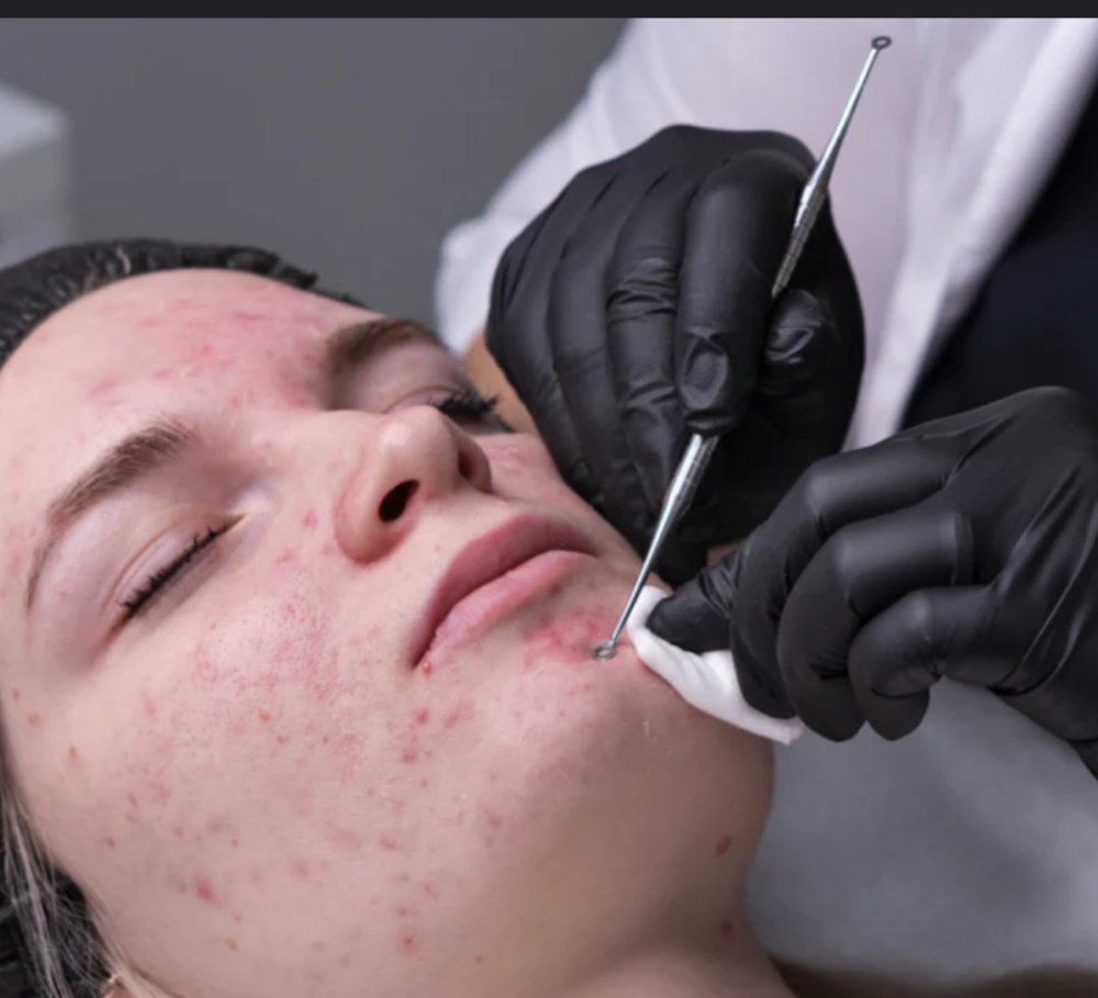 Acne-clearing Facial