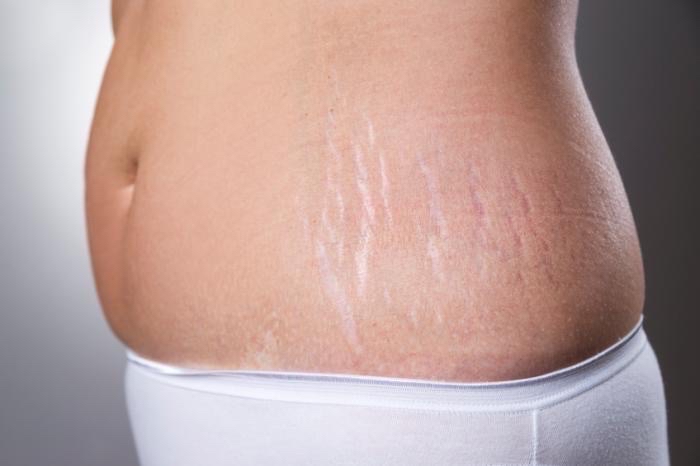 Stretch Mark Removal (Procell)