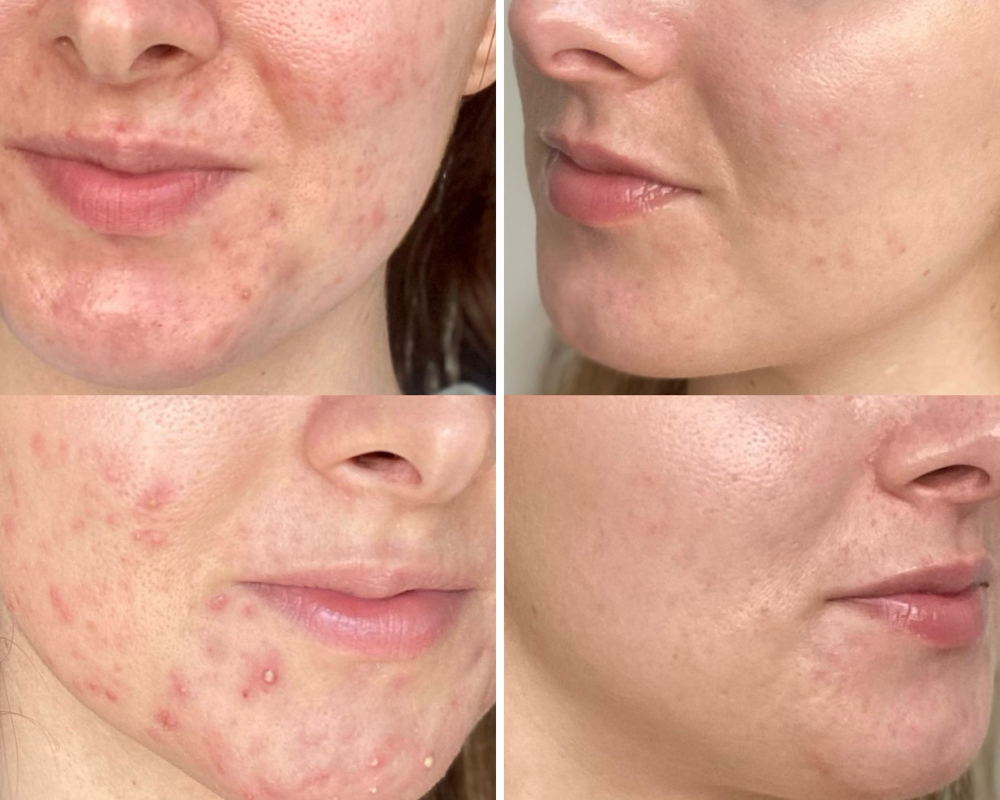 Face Reality Acne Bootcamp