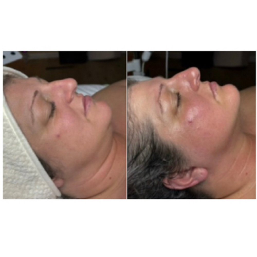 Lymphatic Drainage Facial Massage at Softer Skin Esthetics LLC in Sedalia, MO