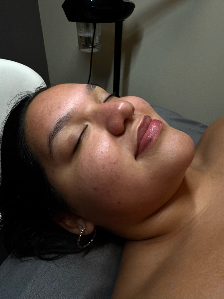 Microdermabraison Facial ❣️