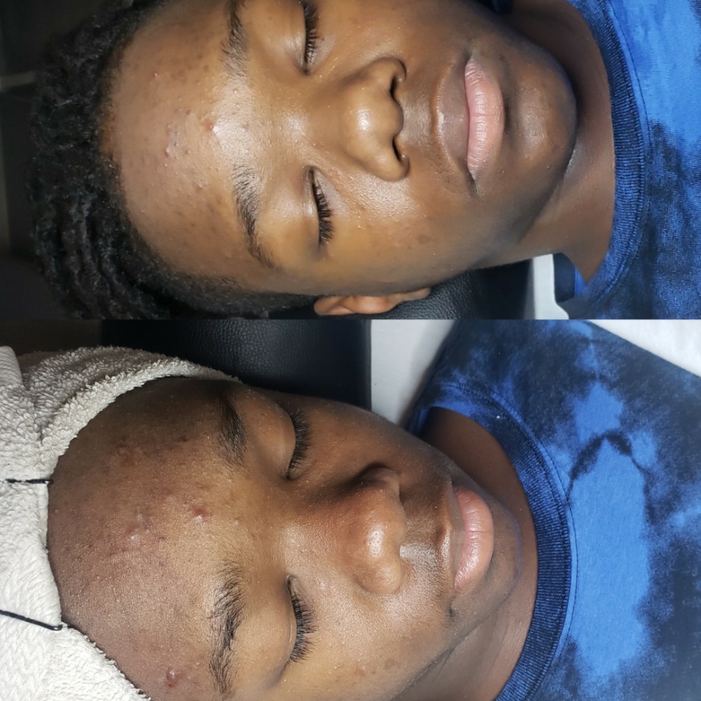 Acne Away Radiance  Facial