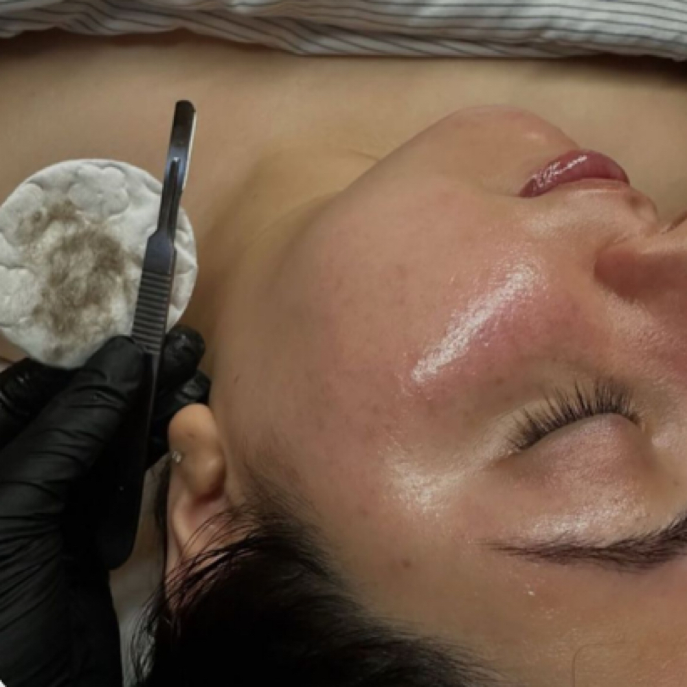 Dermaplane Add On at Admar Esthetics in Martinsburg, WV