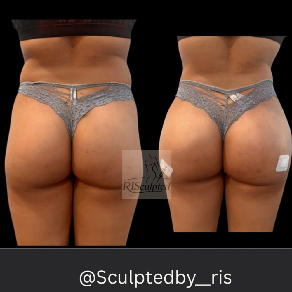 The “Signature” Doll (400ml) at RISculpted Aesthetics in Stockbridge, GA